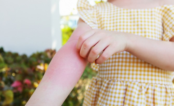 imagen de Alergias alimentarias en niños: ¿cómo detectarlas?
